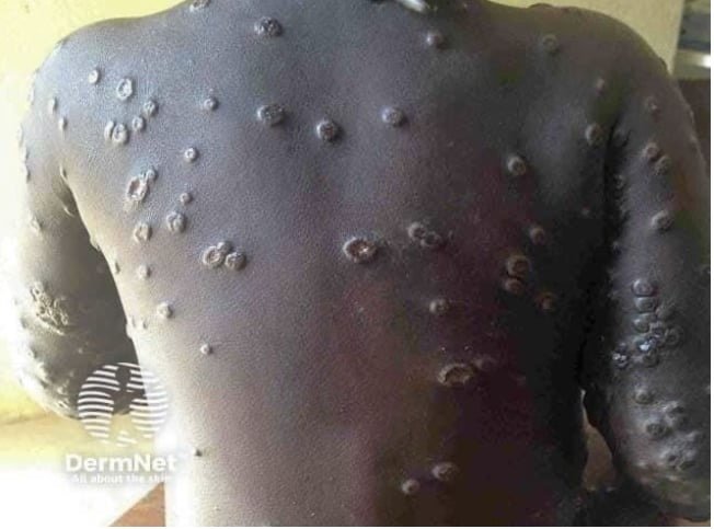 Ministério sul-africano da Saúde vai lançar vacinação contra mpox