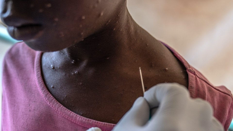 Malawi: Sobe número de distritos afectados pela mpox