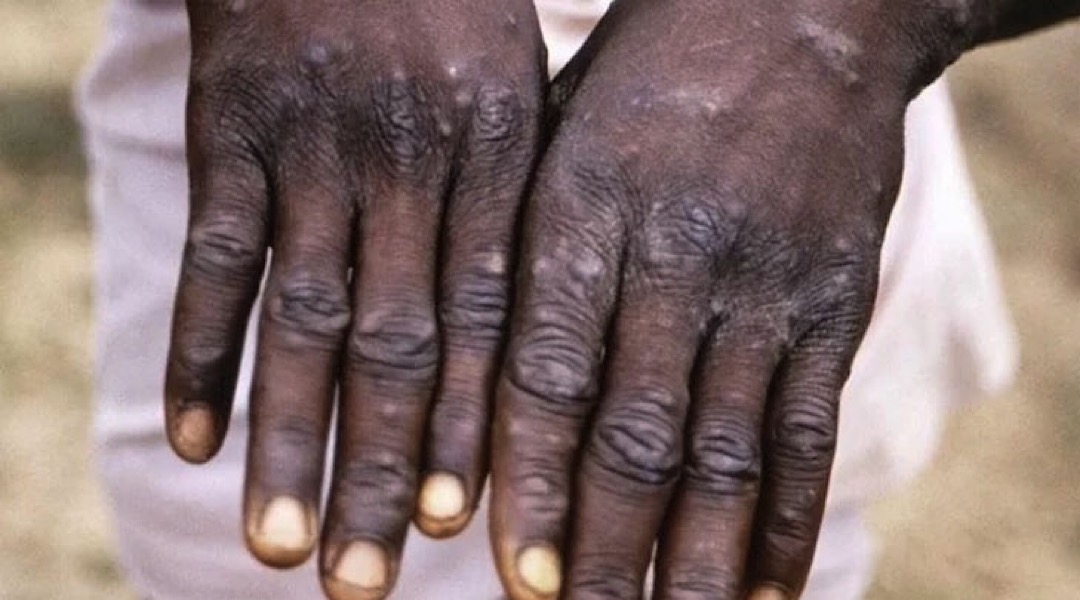  OMS anuncia que mpox deixou de ser uma emergência de saúde...